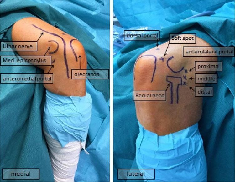 
Hình 1: Các cổng vào trong nội soi khớp khuỷu
