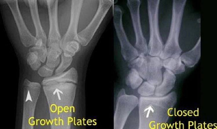 When the bone ossification process ends, the growth cartilage will close because it has completely ossified.
