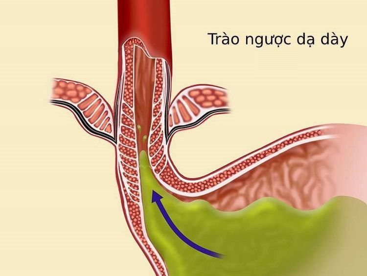 
Trào ngược dạ dày thực quản có thể là nguyên nhân gây vòng đai Schatzki
