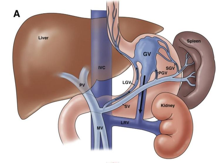 Điều trị xuất huyết tiêu hoá do vỡ búi giãn tĩnh mạch dạ dày bằng can thiệp nội mạch