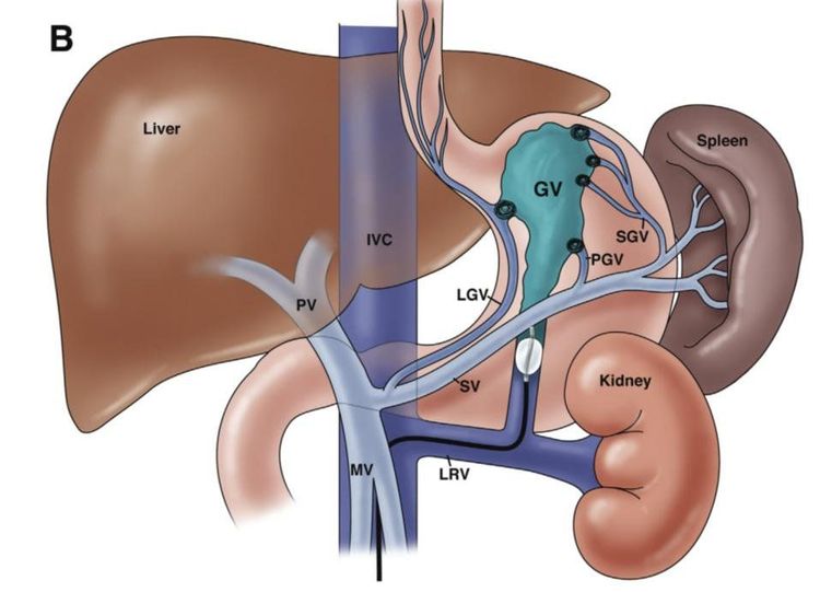 
Hình 1. Minh hoạ về búi giãn tĩnh mạch dạ dày với shunt vị - thận (A) và kỹ thuật nút mạch búi giãn qua can thiệp ngược dòng (B)
