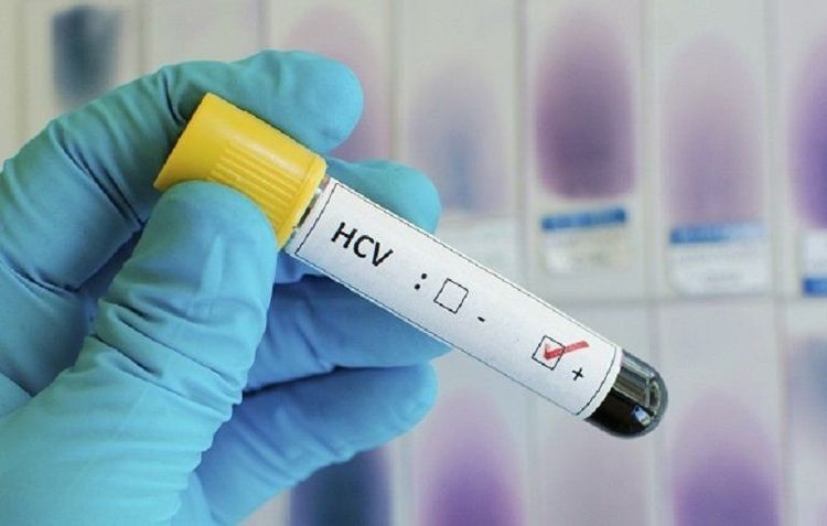 Xét nghiệm anti HCV kết quả định tính có ý nghĩa gì?