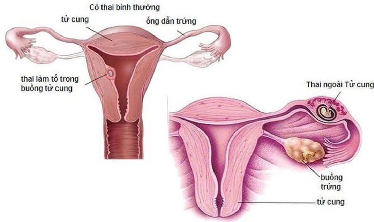 Soi trứng có phòng tránh được thai ngoài tử cung không?