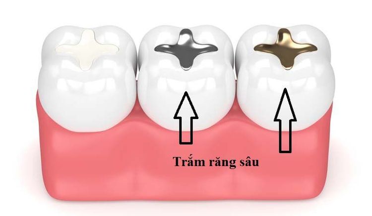 
Trám răng được bao lâu là thắc mắc của nhiều người
