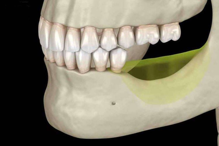 
Khi bị mất răng lâu năm có thể khiến người bệnh bị tiêu xương hàm
