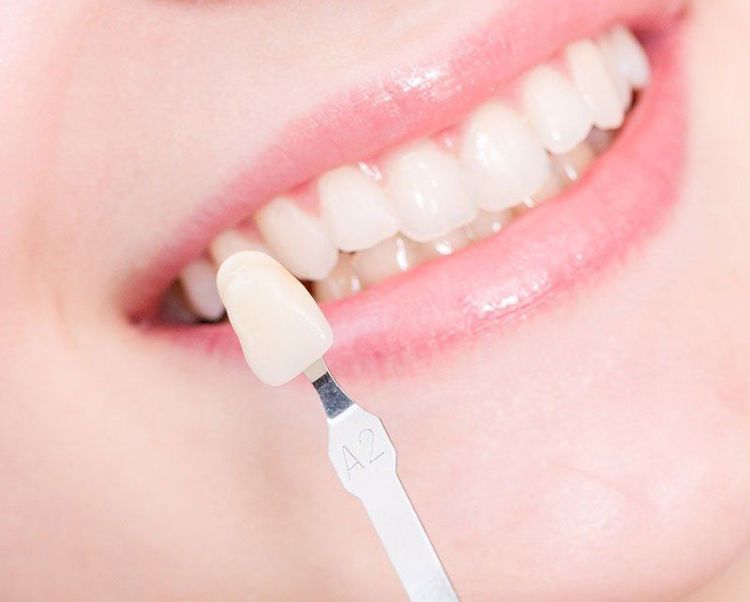 
Giải đáp Veneers là gì?
