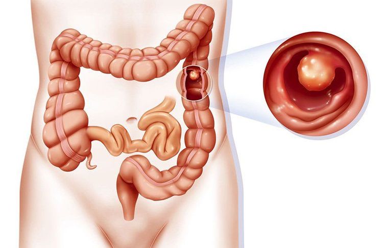 How are female rectal polyps treated?