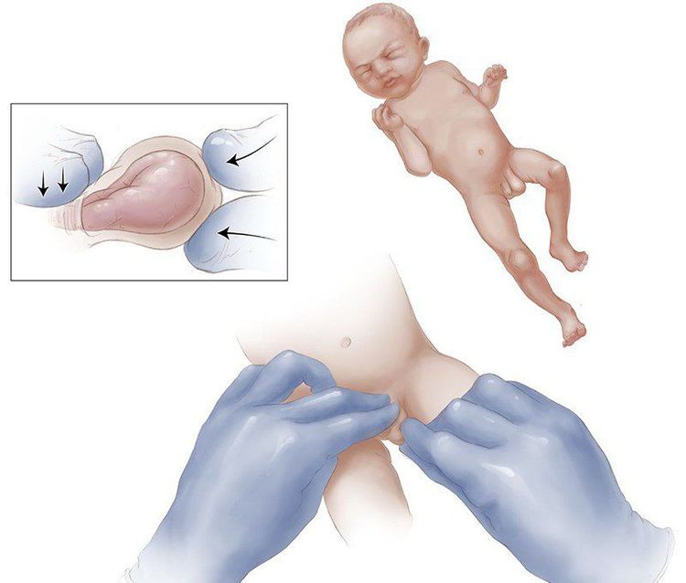 Trẻ thoát vị bẹn trái điều trị như thế nào?