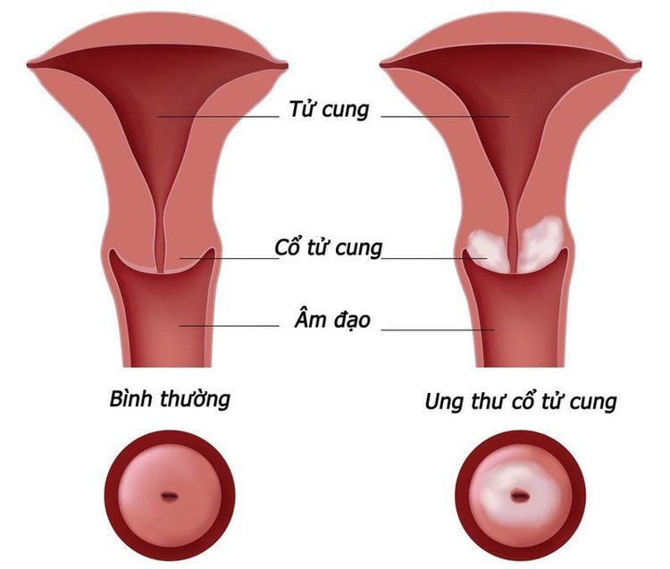 Ung thư cổ tử cung di căn điều trị được không?