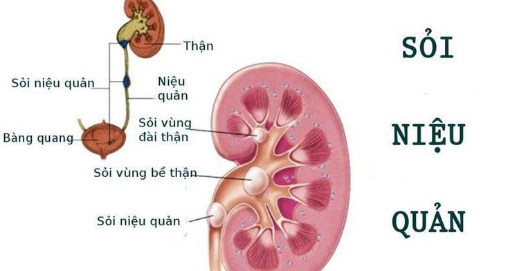 Kích thước sỏi niệu quản 17mm có sao không?