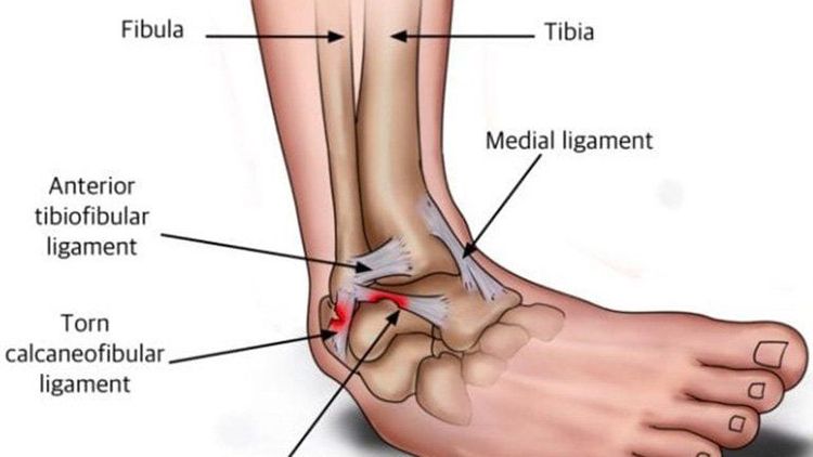 
Tùy thuộc vào mức độ tổn thương dây chằng, giãn và đứt dây chằng cổ chân được phân thành 3 cấp độ
