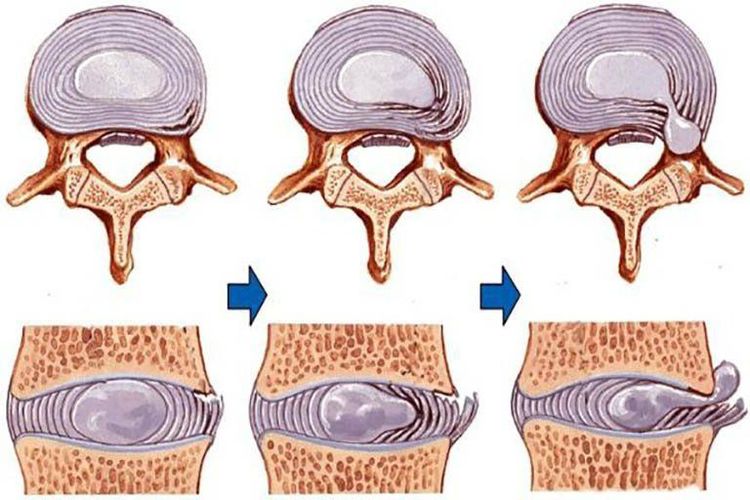 Rách vòng xơ đĩa đệm và nang màng nhện tủy sống nguy hiểm không?