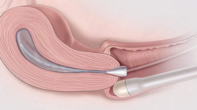 Kỹ thuật bơm nước để súc rửa tử cung là gì?