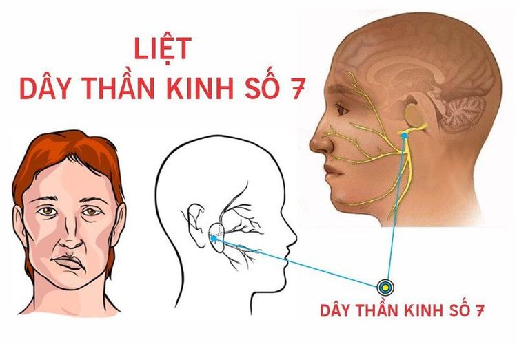 Liệt dây thần kinh số 7 có thể phục hồi được không?