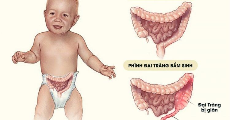 
Hirschsprung là một bệnh lý bẩm sinh gặp ở trẻ sơ sinh
