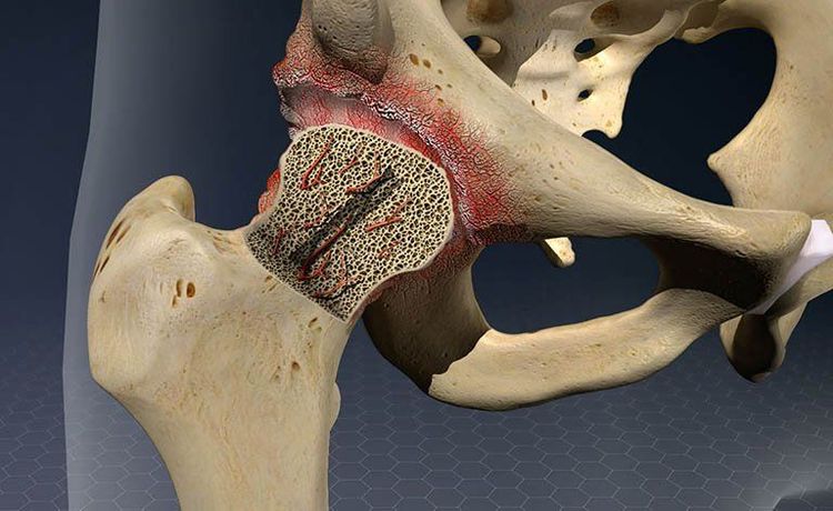 
Người mắc hoại tử khớp háng có thể tham khảo bấm huyệt chữa đau khớp háng
