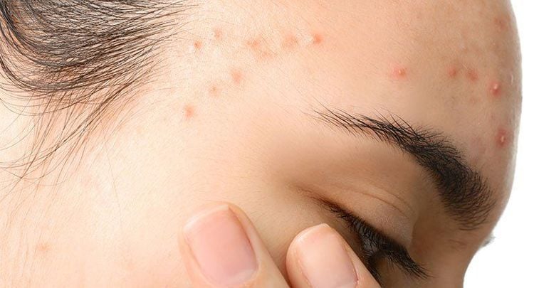 To effectively treat boils, it's important to identify the underlying cause of acne.