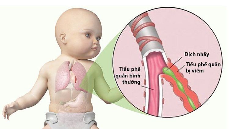 
Viêm tiểu phế quản và những điều cần biết
