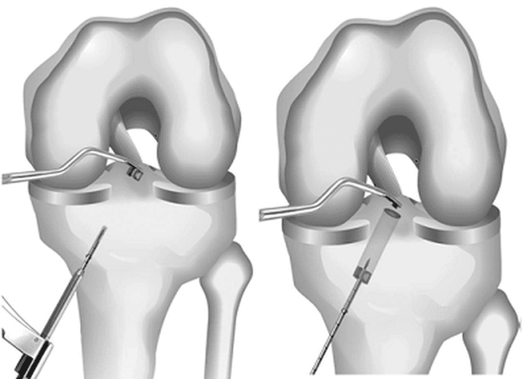 
Tái tạo dây chằng chéo khớp gối và những điều cần biết
