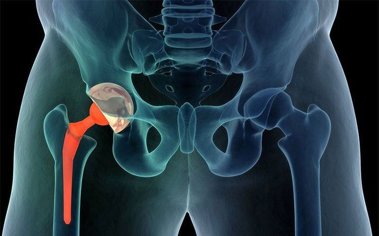 Thoái hóa khớp háng và thay khớp nhân tạo