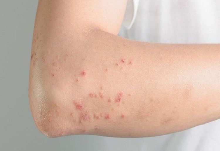 Skin manifestations such as rash and itching are among the side effects of Flagyl 250mg.