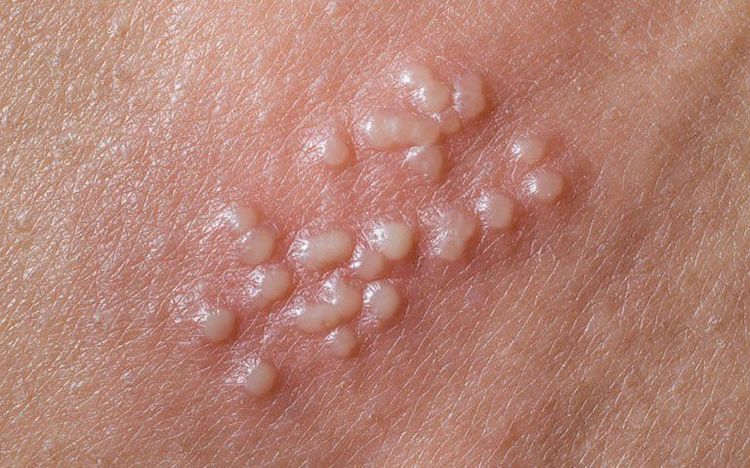 Herpes có thể ngứa, nóng rát, hoặc phát ban