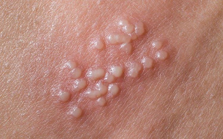 
Hình ảnh herpes sinh dục
