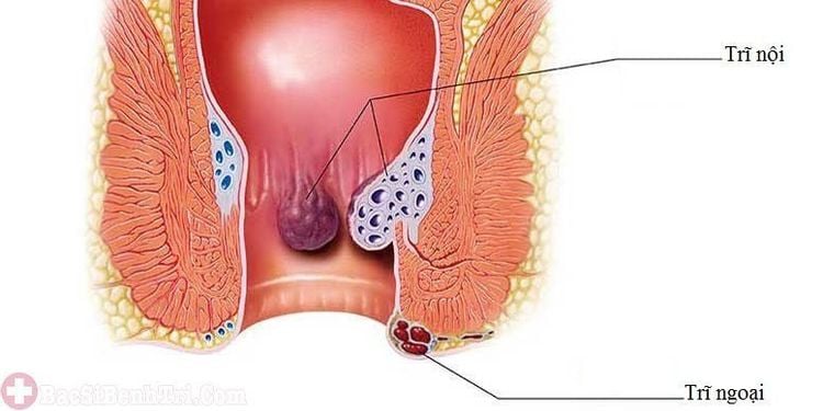 
Bệnh trĩ có thể là nguyên nhân gây chảy máu ở hậu môn
