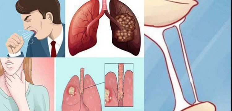 
Ung thư phổi biểu hiện nhiều triệu chứng khác nhau
