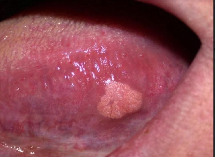 Oral genital warts need to be accurately diagnosed.