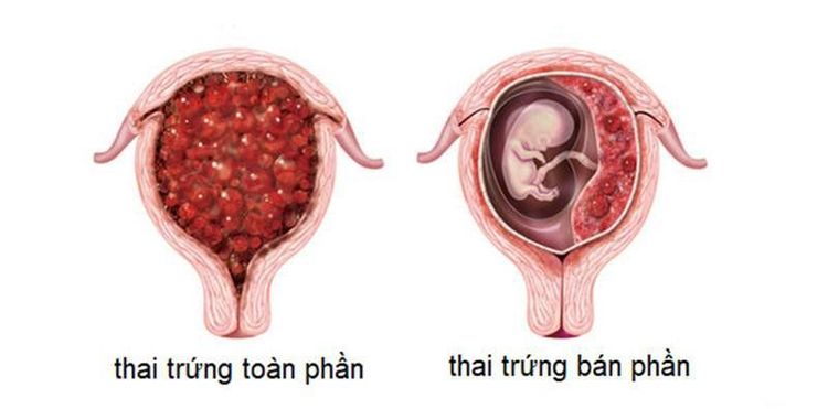 
Hình ảnh mô tả phụ nữ bị thai trứng toàn phần và bán phần
