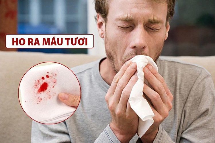 Chẩn đoán lao phổi tái phát: Cách phát hiện sớm và điều trị hiệu quả