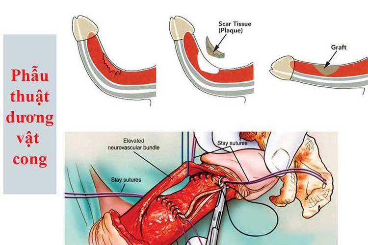 
Phẫu thuật dương vật bị cong
