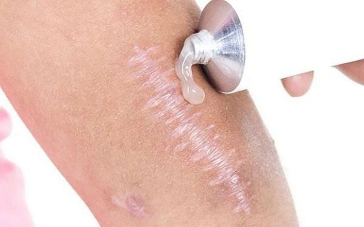 When a scar becomes swollen, topical medications can be used as prescribed by a doctor.