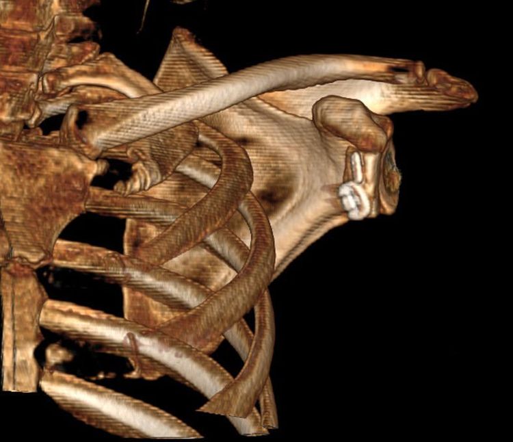 
Hình ảnh CT 3D sau mổ đã ghép xương mào chậu tương ứng với vị trí khuyết xương ổ chảo
