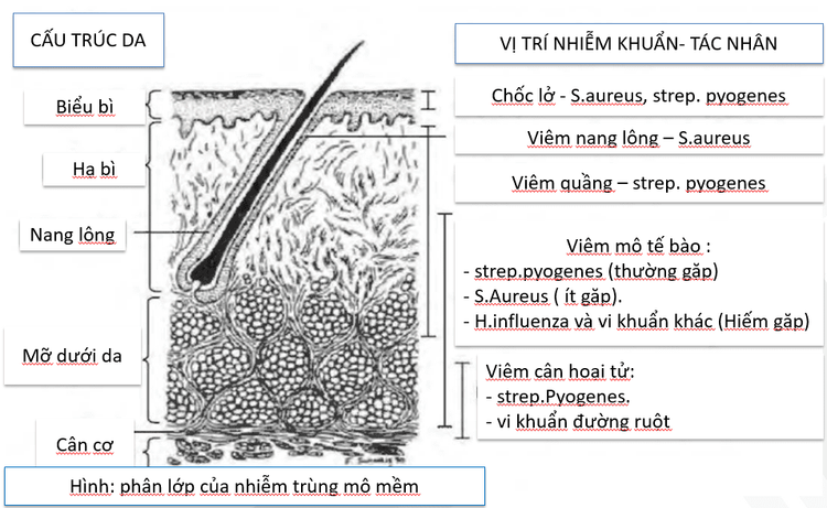 
Phân lớp của nhiễm trùng mô mềm
