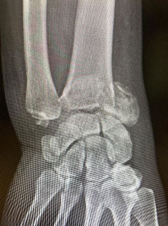 
Mr. Lim has a complicated fracture of the lower head of the left radial bone, as seen on an X-ray.
