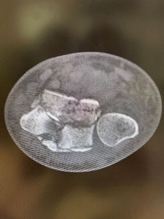 
Mr. Lim's shattered bone as shown on a CT scan
