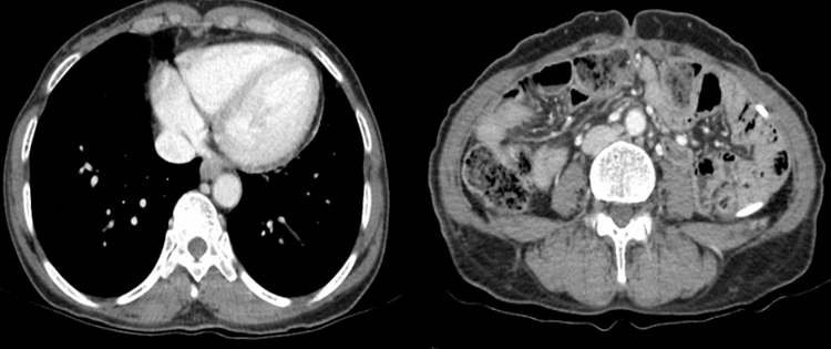 
A CT scan after treatment showed that the patient was free of abdominal and pleural fluid.
