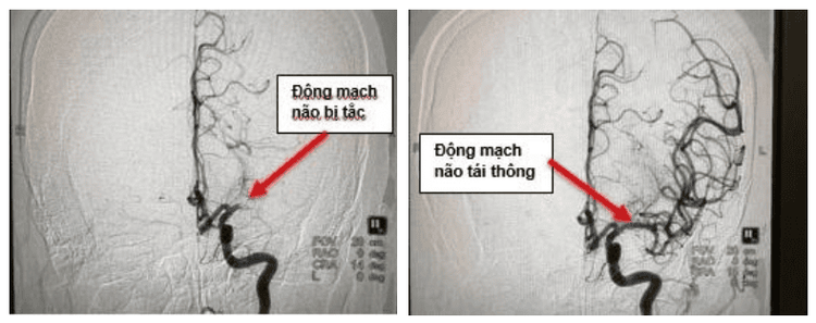 
An angiogram of Ms. Hoa's clogged blood vessels before treatment (left) and after getting intervened (right) by doctors at Vinmec Da Nang.
