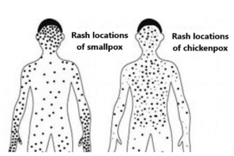 The rash locations of smallpox and chickenpox are different.