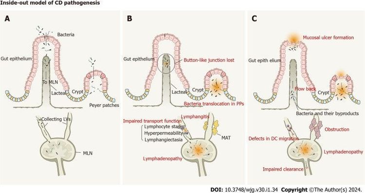 Mô hình bệnh sinh bệnh Crohn cho thấy tác động bệnh lý của hệ thống bạch huyết trong bệnh Crohn 