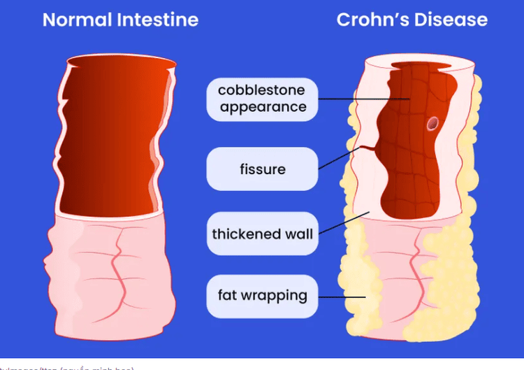 Sự tích tụ mỡ bụng sâu nguy hiểm này có thể dẫn đến những biến chứng nghiêm trọng hơn của bệnh IBD