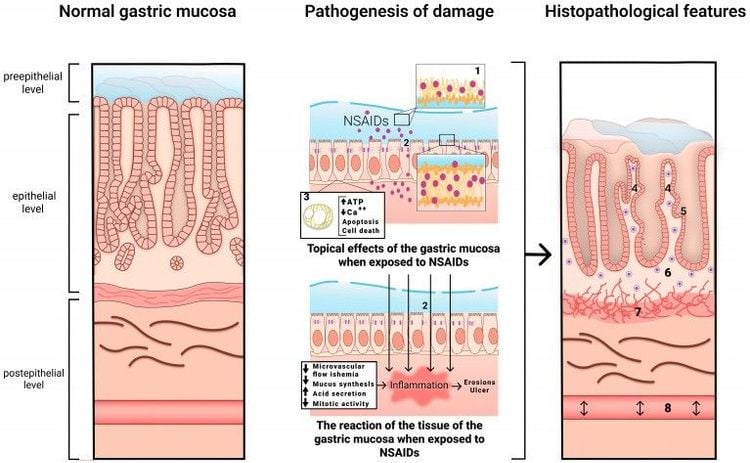 Cơ chế phát triển bệnh lý dạ dày liên quan đến NSAID. 1—lớp đơn phospholipid bị phá vỡ, 2—tổn thương các protein liên kết chặt, 3—ty thể không liên kết, 4—những thay đổi tái tạo rõ rệt ở biểu mô (tăng sản nang lông với nhân tế bào tăng sắc tố, giảm hình thành chất nhầy), 5—tế bào nhầy có không bào dưới nhân, 6—thâm nhiễm đơn nhân khuếch tán nhẹ, 7—bó tế bào cơ trơn ở lớp niêm mạc, 8—phù nề với các mạch máu giãn nở