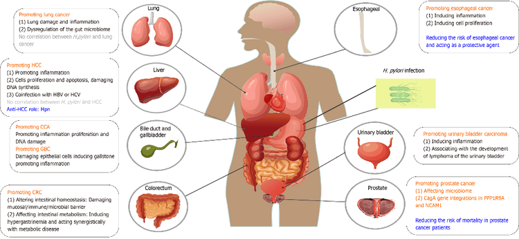 Mối liên quan giữa nhiễm Helicobacter Pylori và ung thư gan, đường mật