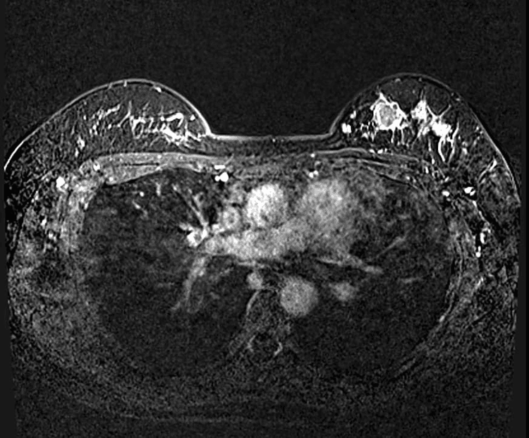 Hình ảnh khối ngấm thuốc vú trái trên phim MRI