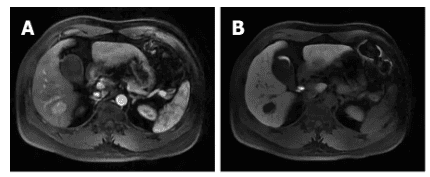 Chụp cộng hưởng từ (MRI) khối u biểu mô quanh mạch gan (PEComa) ở một nam giới 37 tuổi: tổn thương nằm ở S6 cho thấy sự tăng cường rõ rệt trong thì động mạch gan (A), tăng cường viền ở thì muộn (B)