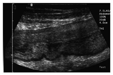 Hình ảnh siêu âm của đoạn đại tràng bị viêm trong bệnh Crohn. Hình ảnh đặc trưng: đường kính thành dày (gần 1 cm), mất một phần lớp phân tầng thành, lớp dưới niêm mạc nổi rõ, lòng đại tràng hẹp và phì đại mỡ mạc treo