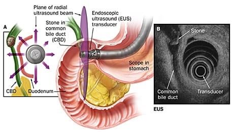 Kỹ thuật siêu âm qua nội soi

