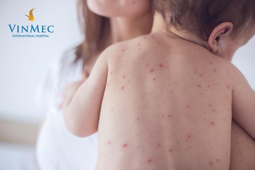 Be alert and handle the symptoms of measles in children in Winter - Spring